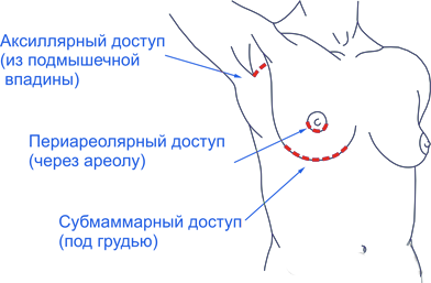 Доступ установки имплантатов