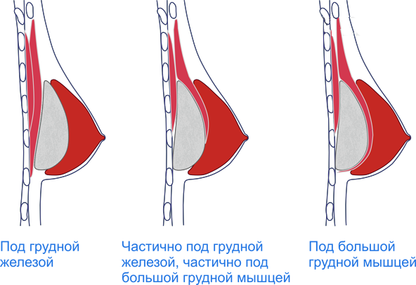 Установка имплантата